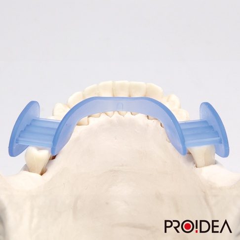淺藍色靜音牙套，由半透明的矽膠材質製成，呈U型設計，兩側有圓形翼狀支撐，置於牙齒模型上，用於展示產品功能。